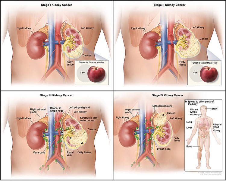 Kidney Cancer Texas Oncology